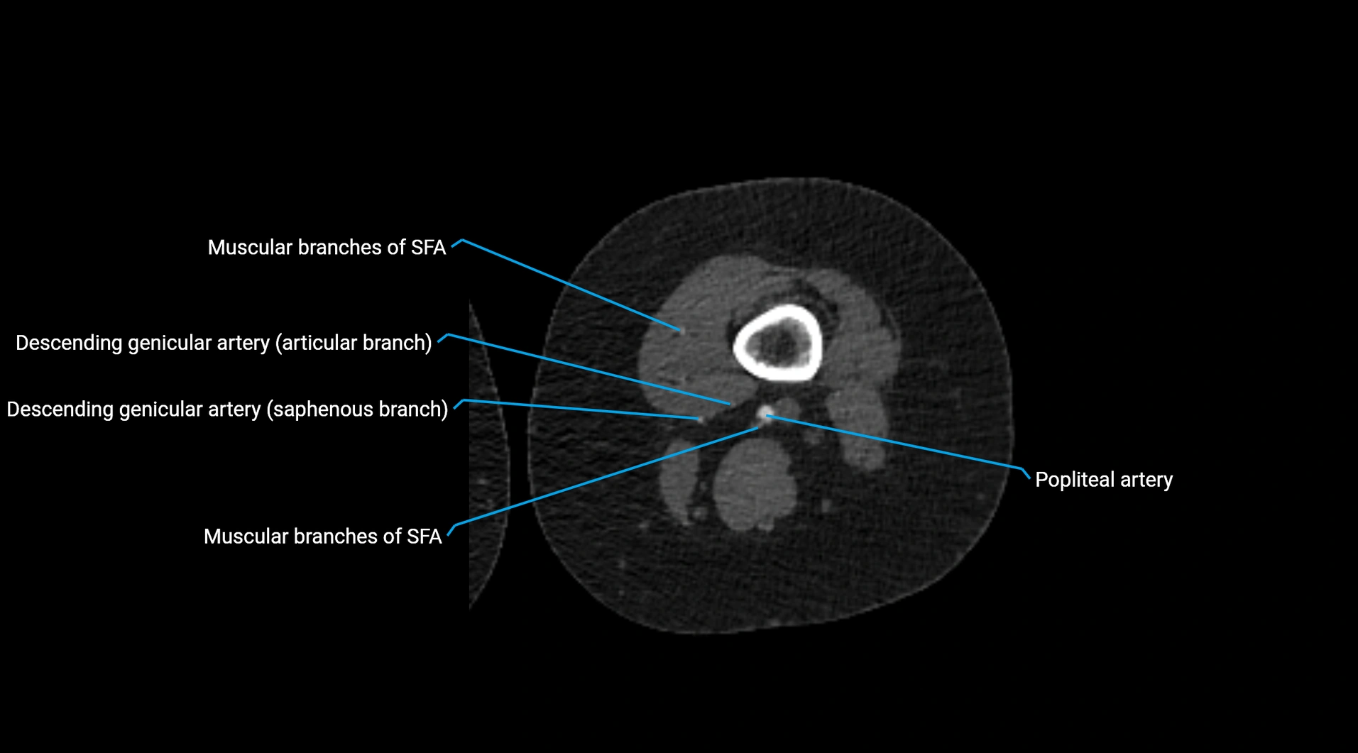 CTA lower limb cross sectional anatomy labelled image _154.webp